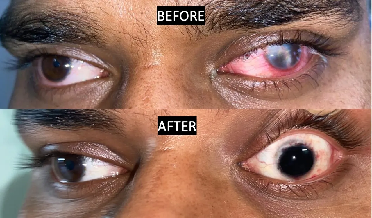 Corneal scar treatment – tattoing