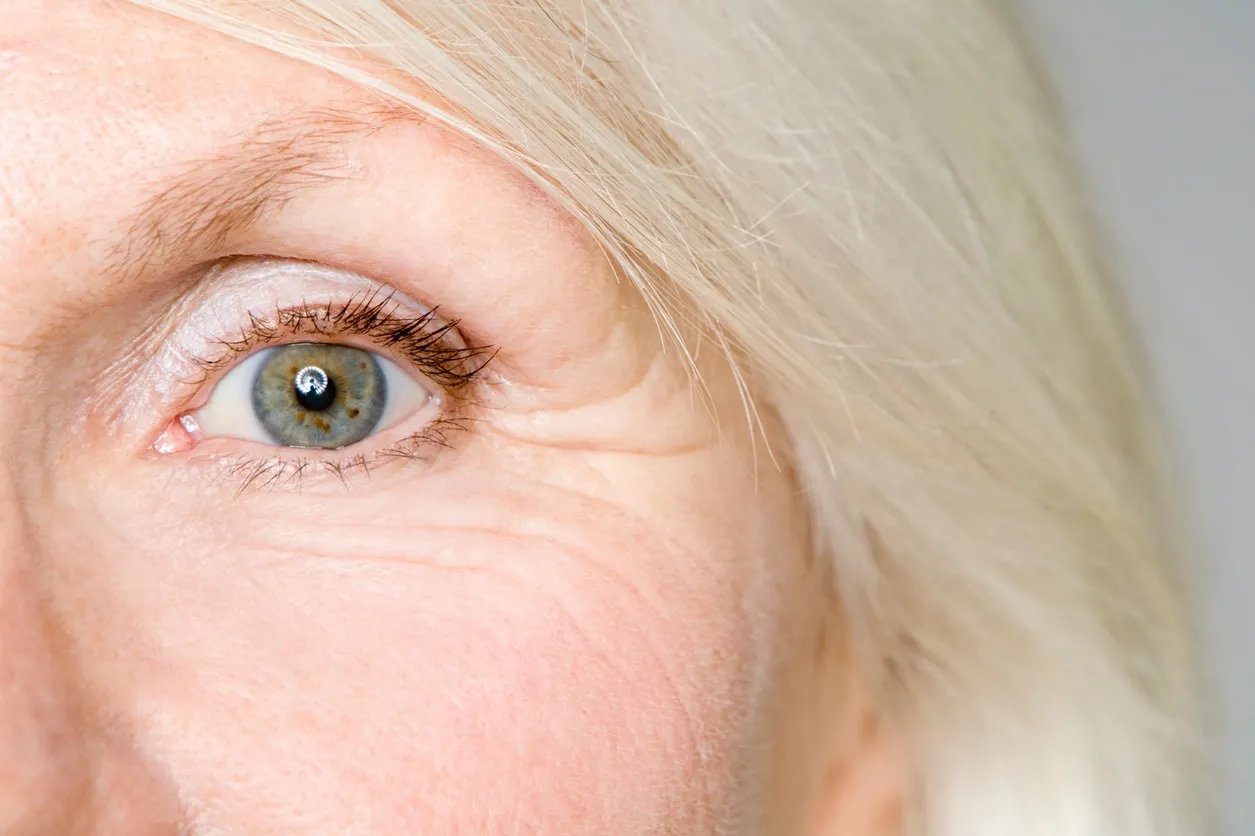 What is dry eye? Symptoms, causes and prevention.