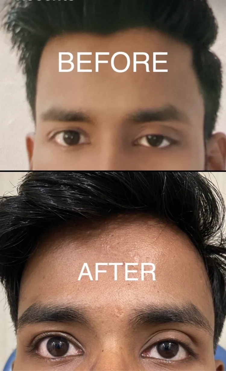 Treatment of ptosis using eye drops – Brimonidine.