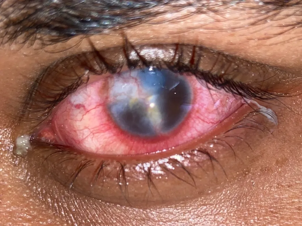 Corneal Ulcer: General guidelines for care