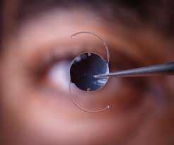 Best imported lens for Cataract Surgery: A Comprehensive Guide