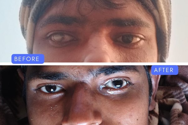 Corneal Scar Treatment