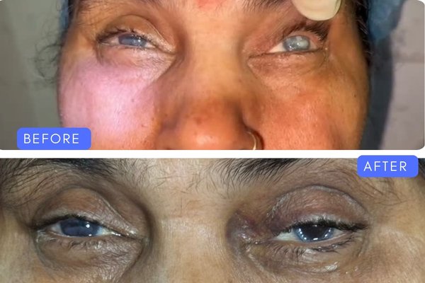 Before and after result of cataract eye surgery at Tewari Eye Centre showing clear eyes