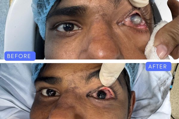 Before and after comparison of severe corneal opacity treatment