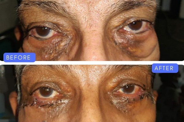 Before and after lower eyelid reconstructive surgery results