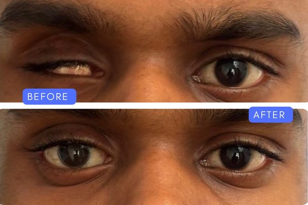 Before and after visual result of custom prosthetic eye placement