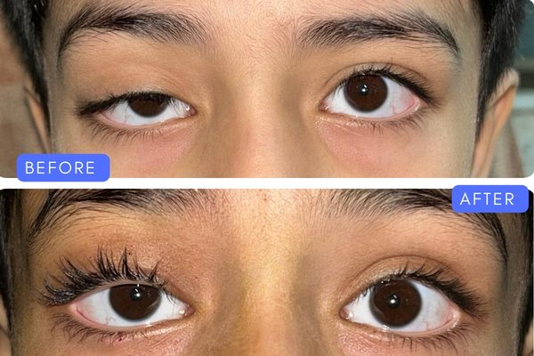 Before and after view of ptosis drooping eyelid correction surgery