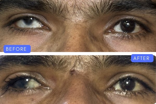 Before and after comparison of squint eye alignment correction surgery