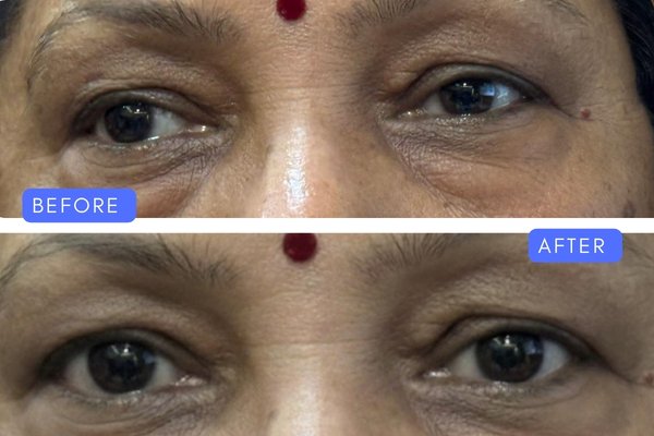 squint treatment