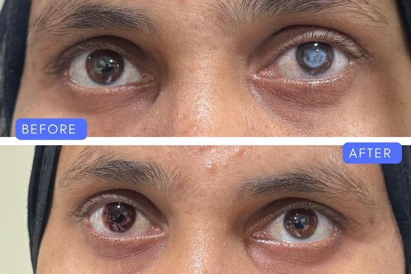 Before and after comparison of advanced white cataract surgery treatment